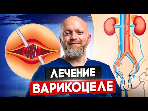 Стоит ли бояться операции при варикоцеле? Современная хирургия без мифов
