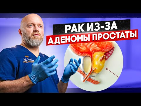 РАК ПРОСТАТЫ и аденома предстательной железы- какая связь? Что нужно знать каждому мужчине!